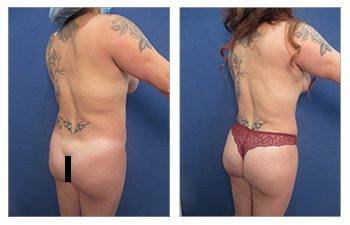 360 Liposuction or Liposuction area-by-area - Which One is Better?