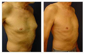 gynecomastia surgery be covered by insurance