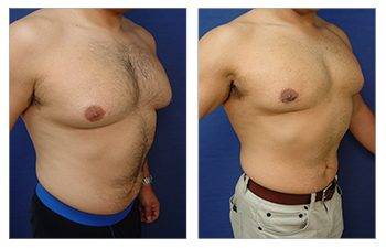 gynecomastia surgery