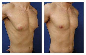 What Is the Gynecomastia Pinch Test?