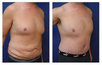 Male breast surgery versus gynecomastia surgery