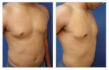 gynecomastia surgery leave scars