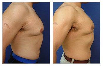 gynecomastia surgery