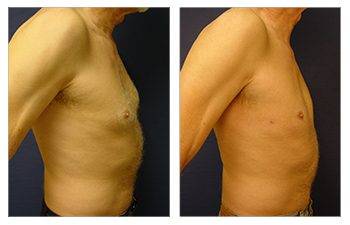 gynecomastia surgery be covered by insurance