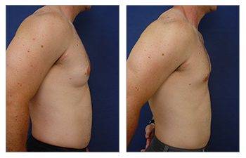 Does gynecomastia surgery reduce nipple size