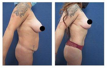 360 Liposuction