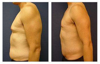 gynecomastia surgery worth it