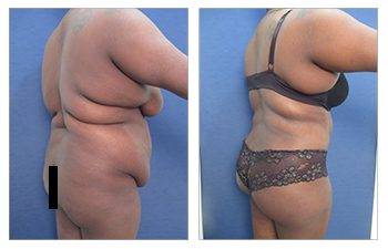 Brazilian Buttock lift for plus sized clients