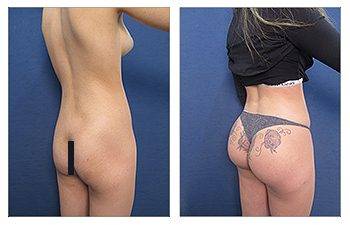 buttock augmentation with implants 