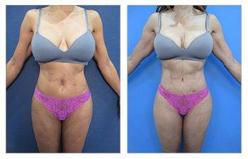 How Do Results Improve with Time After High Definition Body Contouring