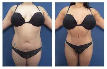 Tummy tuck before and after High Definition Liposuction Revision.