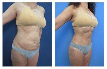 Advanced Liposuction Revision
