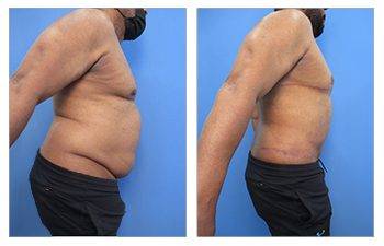 Male Back Liposuction