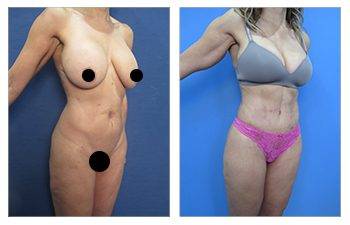 High Definition Liposuction Gender Specific Differences