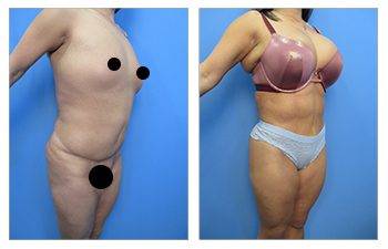 How To Liposuction Love Handles For Best Results - Moein Surgical Arts