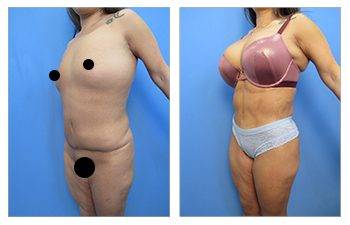 What is a Breast Lift with Implants Over the Muscle