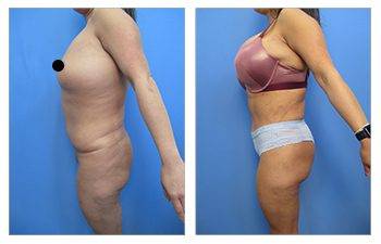 Best Liposuction, SurgiSculpt