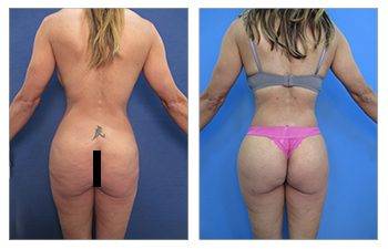 Increase in Brazilian Buttock Lifts in California