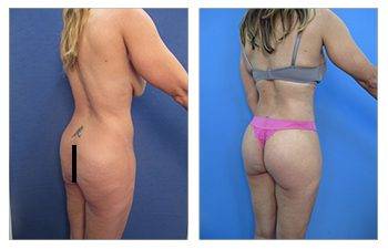 Increase in Brazilian Buttock Lifts in California