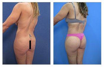 Increase in Brazilian Buttock Lifts in California