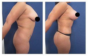 Awake Tummy Tuck