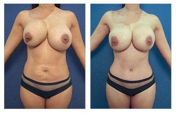 How does implant size affect bra cup size?