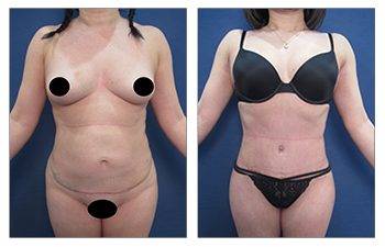 What is Safe Liposuction?