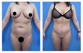 What is VASER High Definition Liposuction