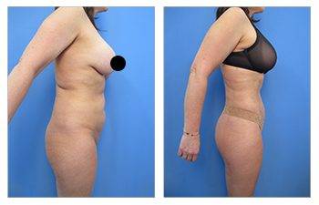 What is VASER High Definition Liposuction