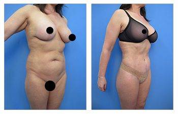 What is VASER High Definition Liposuction