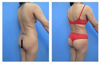 What Is The Skinny Brazilian Buttock Lift