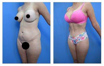 Liposuction with a Tummy Tuck