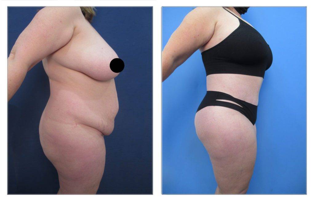 Insulin Resistance Affect Cosmetic Surgery