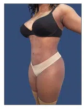 Woman wearing black bra and beige high-waisted shapewear against a blue background, showcasing the results of Newport Beach Plastic Surgery.