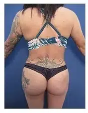 A woman with tattoos on her Newport Beach Plastic Surgeon butt.