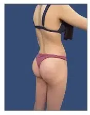 A woman in a bikini flaunting her enhanced buttocks