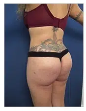 SurgiSculpt® BRAZILIAN BUTT LIFT