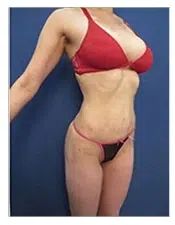 BODY CONTOURING