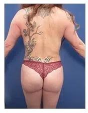 SurgiSculpt® BRAZILIAN BUTT LIFT