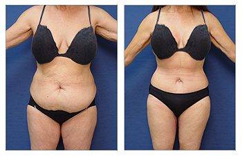 GMommy Makeover Medial Thigh Tuck