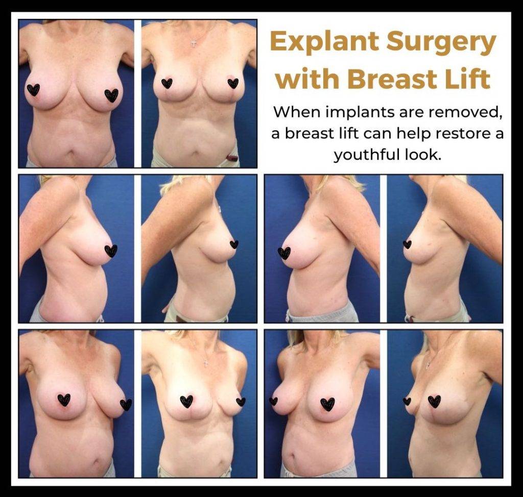 Explant surgery with breast lift