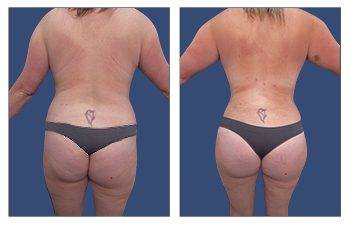 Brazilian Buttock Lift Beverly Hills