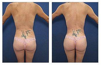 Brazilian Butt Lift Revision Before And After