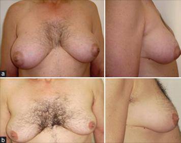 High Definition Liposuction in Gynecomastia