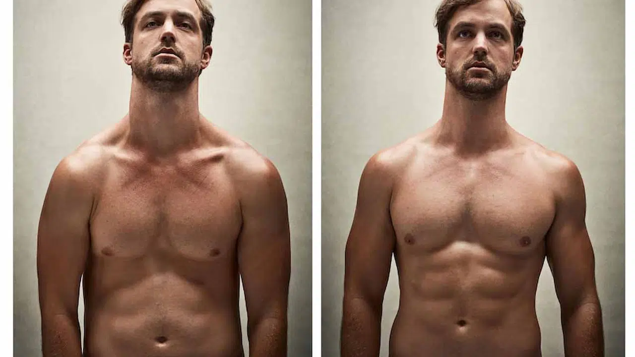 Gynecomastia Surgery Before and After