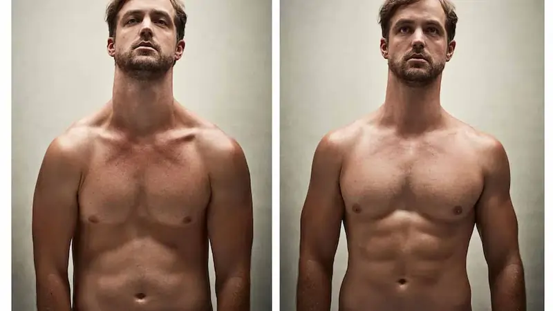 Gynecomastia Surgery Before and After in LA, CA