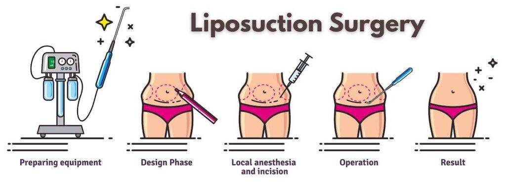 Liposuction near me