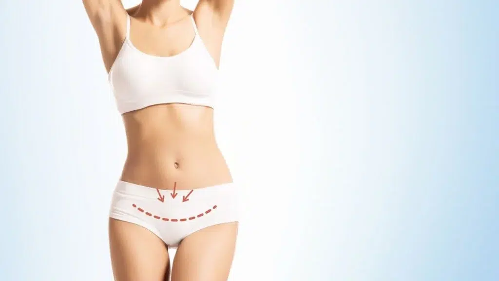 A woman in white underwear with arrows pointing to her waist, understanding the Mini Tummy Tuck.