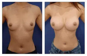 Free Natural Breast Augmentation with Liposuction 360