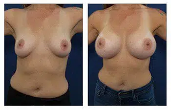 A woman's breast before and after surgery, emphasizing techniques to avoid breast asymmetry during breast augmentation.